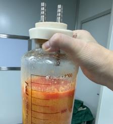 图木舒克水动力吸脂手术要做多久？